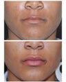 Juvederm