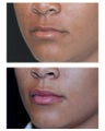 Juvederm