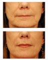 Juvederm