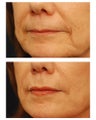 Juvederm