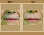 Lip Augmentation