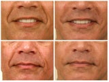 Juvederm