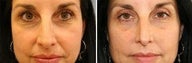 45 years old / two weeks post lower eye lid with fat transpositioning and Juvederm in nasolabial folds.