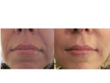 Juvederm Ultra XC & Ultra Plus XC