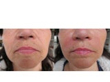 Juvederm Ultra & Ultra Plus XC