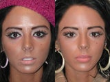 Lip Augmentation