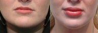 Lip Augmentation