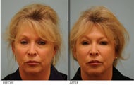 Juvederm