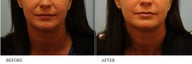 Juvederm
