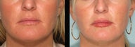 Juvederm