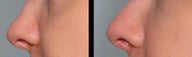 Juvederm