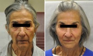 Facial Fillers + Chemical Brow Lift