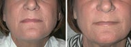 Juvederm Treatment to Naso-labial folds