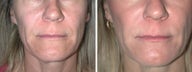 Juvederm Treatment to Naso-labial folds