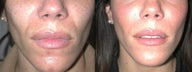 Juvederm to Laugh Lines