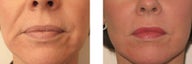 Juvederm and Botox around mouth