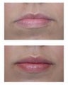 Juvederm