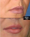 Lip Fillers