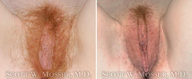 Labiaplasty