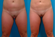 Labiaplasty