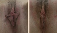 Labiaplasty