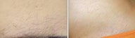 IPL hair removal bikini area