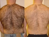 Laser Hair Removal