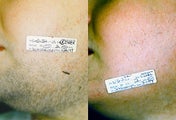 Laser Hair Removal