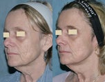 Fraxel repair with C02/Erbium lasers for upper lip wrinkles