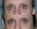 Fraxel repair with C02/Erbium lasers for upper lip wrinkles