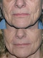 Fraxel repair with C02/Erbium lasers for upper lip wrinkles