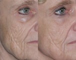 Fraxel repair with C02/Erbium lasers for Upper lip wrinkles