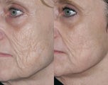 Fraxel repair with C02/Erbium lasers for upper lip wrinkles