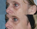 Fraxel repair with C02/Erbium lasers for upper lip wrinkles