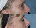 Fraxel repair with C02/Erbium lasers for upper lip wrinkles