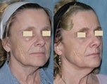 Fraxel repair with C02/Erbium lasers for upper lip wrinkles