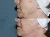 Face and Neck Fraxel repair with C02/Erbium lasers for upper lip wrinkles