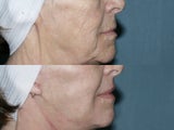 Fraxel repair with C02/Erbium lasers for facial wrinkles