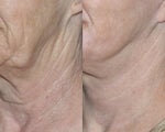 Fraxel repair for neck with C02/Erbium lasers