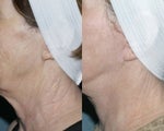 Fraxel repair for neck with laser peel treatment