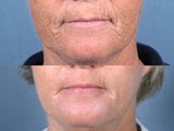 Laser Resurfacing
