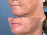 Laser Peel Treatments