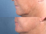Laser Resurfacing