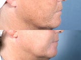 Laser Peel Treatments