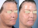Laser Resurfacing