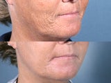 Laser Resurfacing