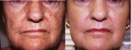 Laser resurfacing of the face and lips