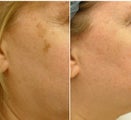 Fractionated resurfacing, QS Alexandrite laser, V-Beam laser