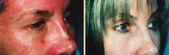 Laser Skin Resurfacing & Eyelid Surgery