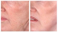 Wrinkle treatment near mouth
